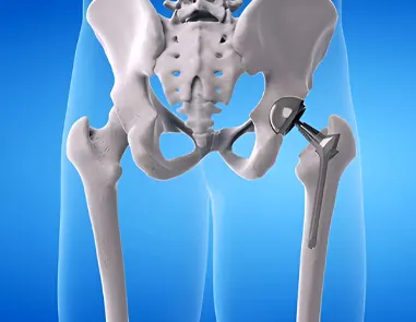 Top Hip Replacement Surgeon in Dwarka – Trusted Orthopedic Specialist